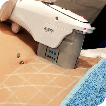 HIFU Body Treatment